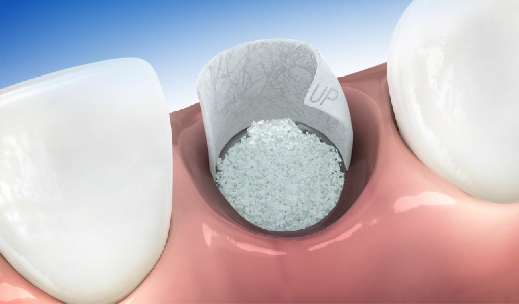 Implantes dentales en Sant Carles de la Ràpita